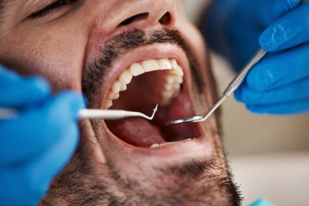 Best Emergency Dental Filling Replacement  in Edgerton, WI